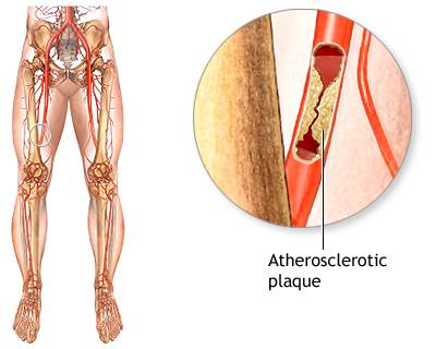 peripheral artery disease specialist in Ludhiana